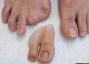 Cosmetic Restoration Finger/Toe