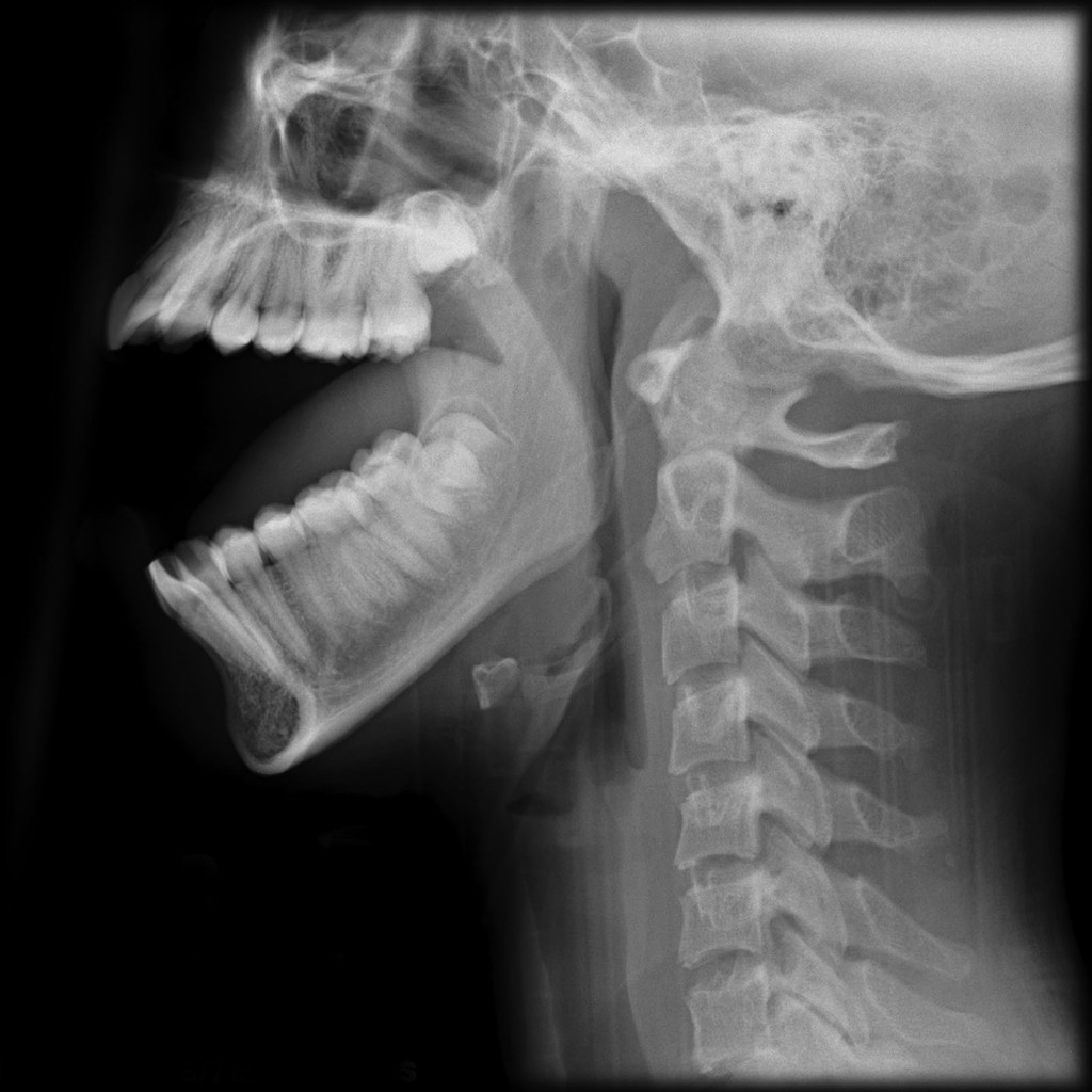 Mandible – Orthopantomogram (OPG)Machine